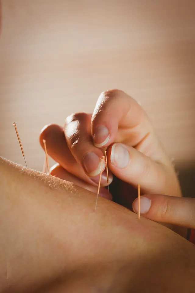 A practitioner’s hand placing fine acupuncture needles