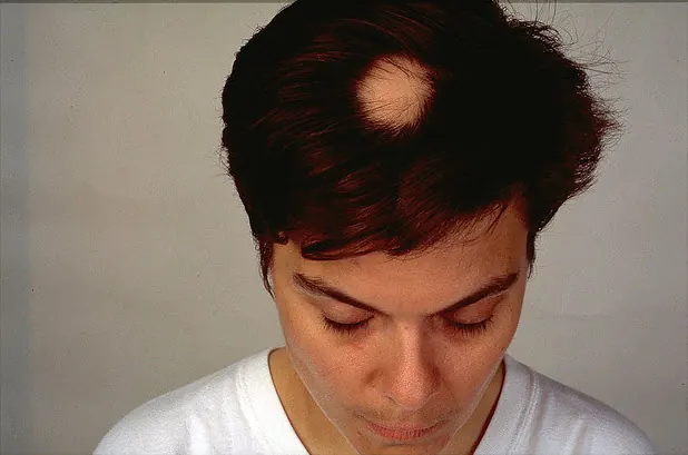 Alopecia Areata